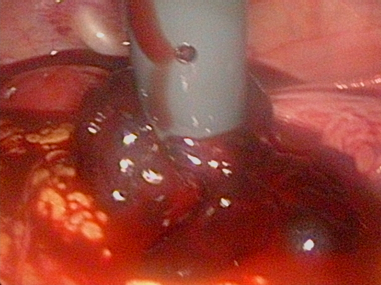 ruptur corpus lutem blood in pelvis